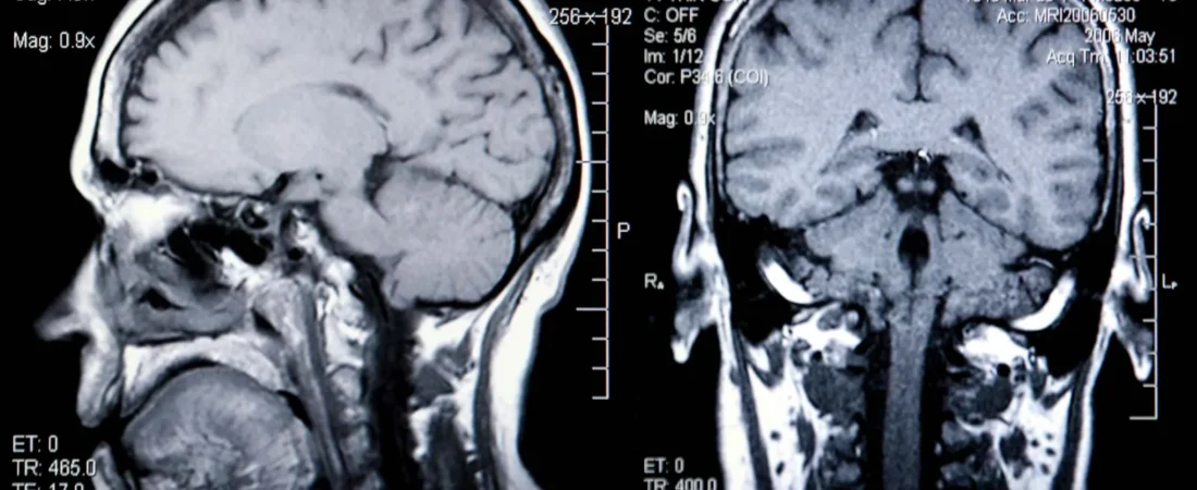 Whiplash and Soft Tissue Injuries: Why They’re Often Underestimated