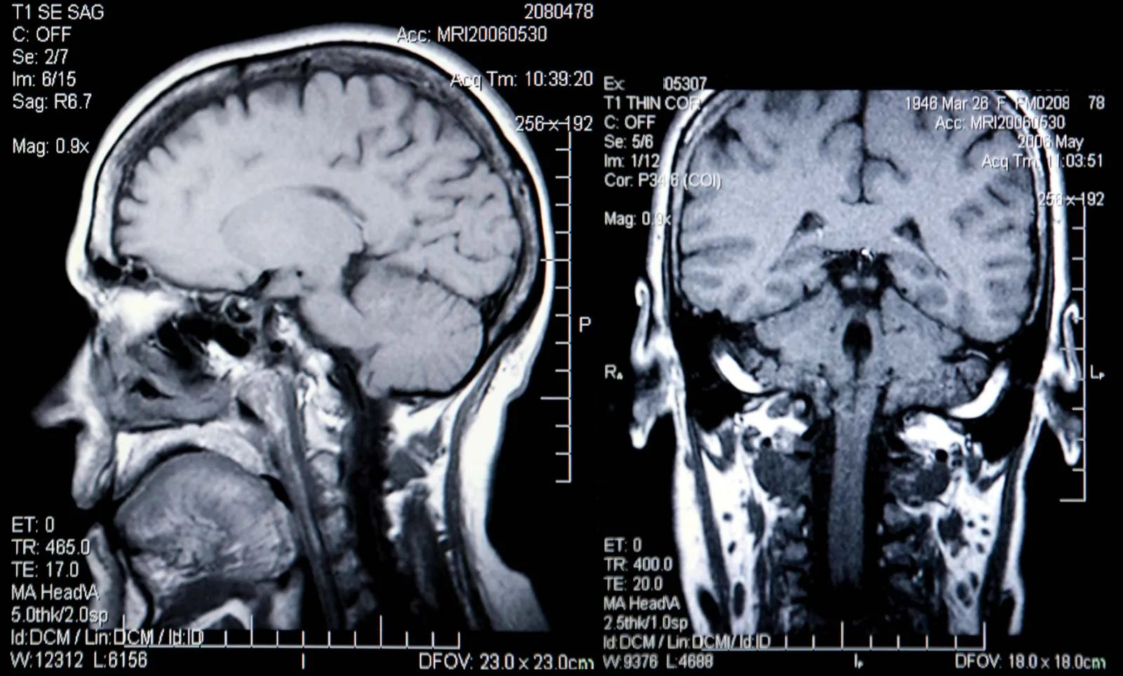 Whiplash and Soft Tissue Injuries: Why They’re Often Underestimated